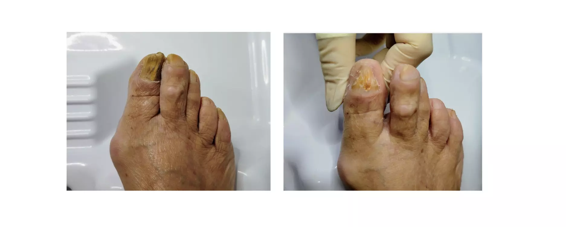 Limpieza profunda de onicomicosis