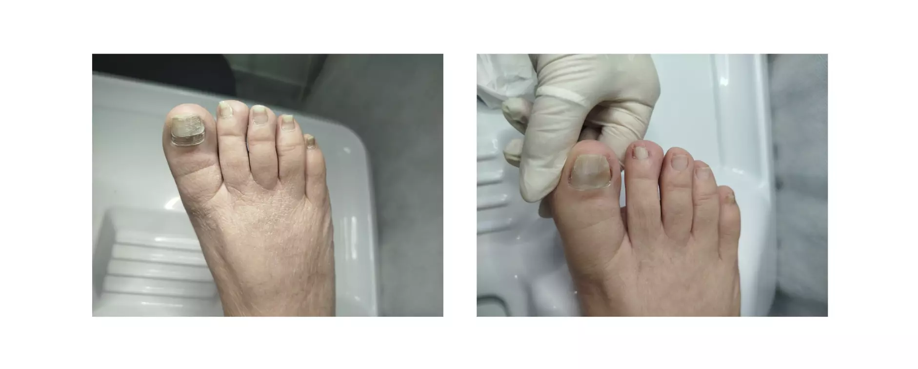 Encarillamiento de uñas