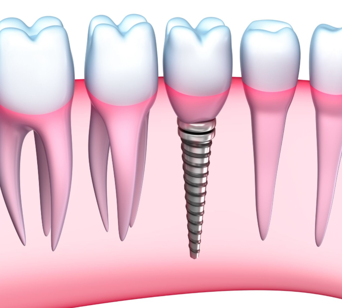 Implantes Dentales