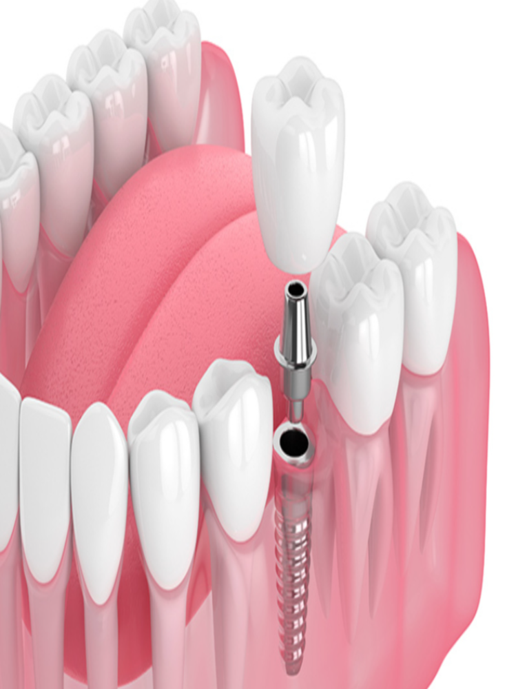 Implantes dentales