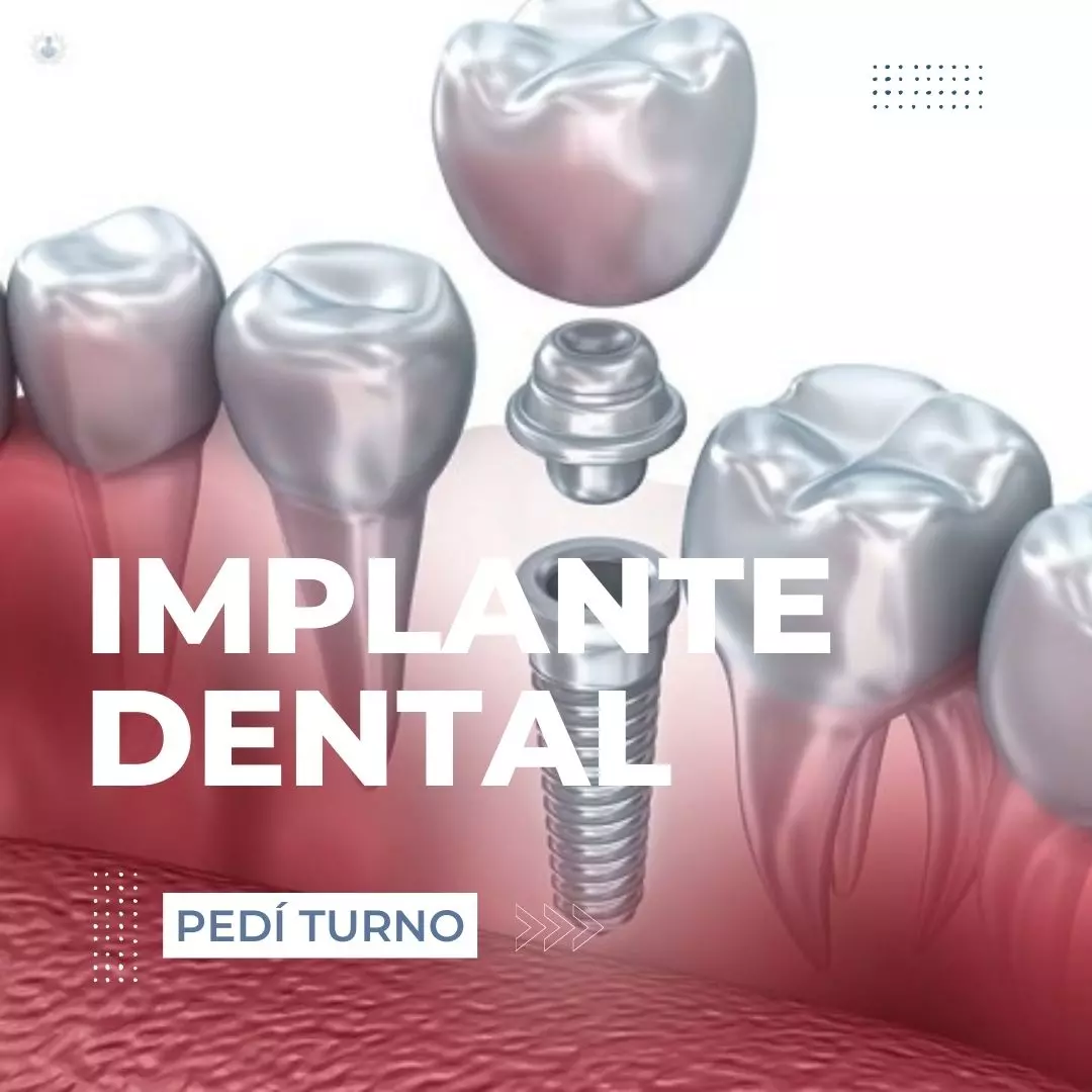 Implante dental